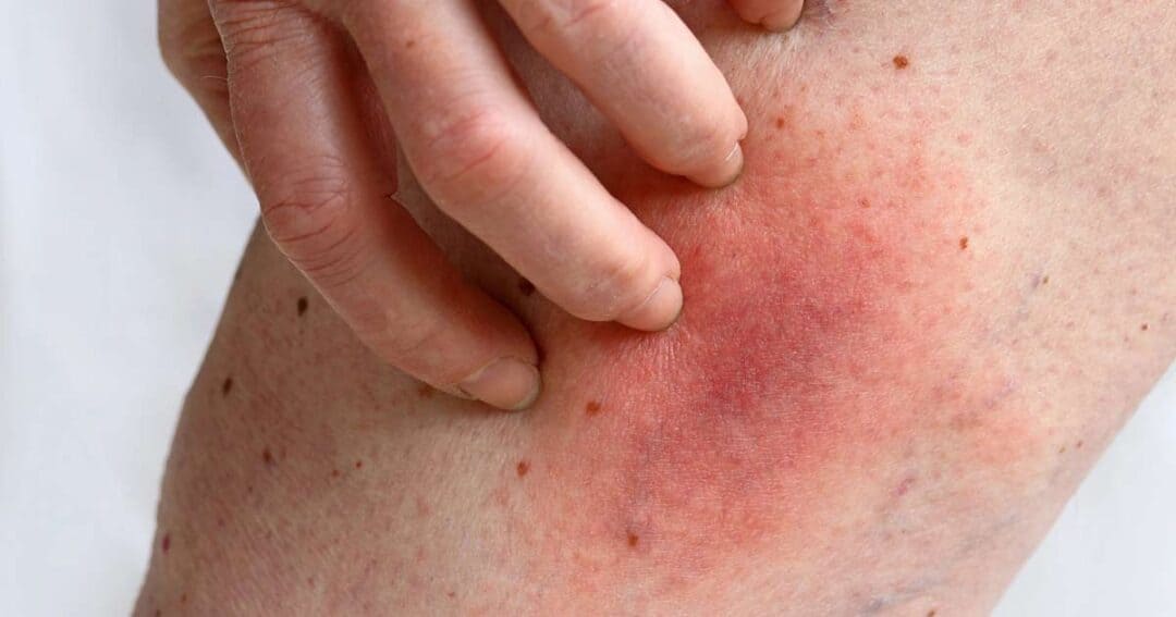 Allergic reaction to a bee sting on a woman's leg. Her hand is scratching the red, irritated site.