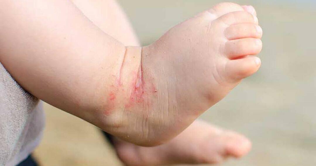 Close-up of a baby's foot with irritated and reddened skin around the ankle, possibly due to eczema or a rash. The background is blurred and neutral, focusing on the foot's condition.