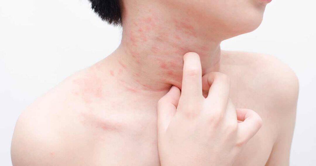 What is Chronic Urticaria? 1 Close-up of a person scratching their neck, which has visible red patches of skin irritation or hives. The plain background highlights the affected area on the neck and shoulder.