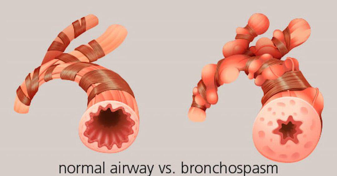 Illustration comparing a normal airway with smooth, open passages on the left to a bronchospasm on the right, showing narrowed airways with constricted muscles and inflamed tissue.