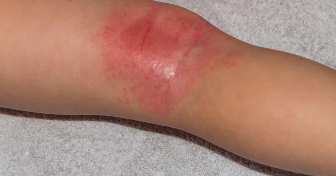 A close-up image of a person&rsquo;s knee shows a large, red, inflamed rash, likely due to contact dermatitis. The skin appears irritated and possibly swollen, suggesting an allergic reaction. The background is a soft, neutral color, likely a towel or fabric.