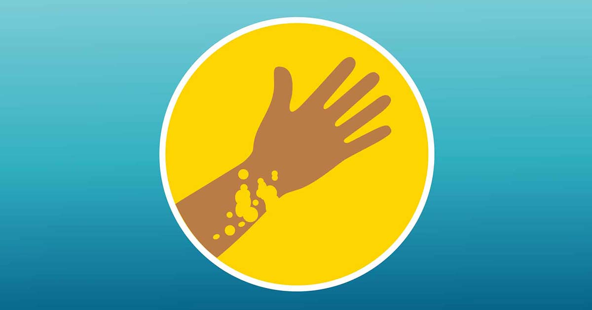 Chronic Urticaria In the Hispanic/Latino Community 9 Chronic Urticaria In the Hispanic/Latino Community