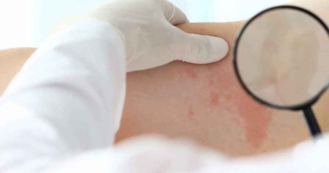 A person with light skin is being examined for skin irritation or rash using a magnifying glass. A gloved hand gently holds the area to inspect the red patches.