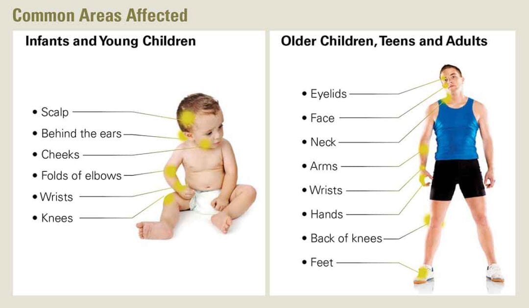 A diagram showing common eczema areas. On the left, an infant with highlighted areas: scalp, behind ears, cheeks, elbows, wrists, knees. On the right, an adult with highlighted areas: eyelids, face, neck, arms, wrists, hands, knees, feet.