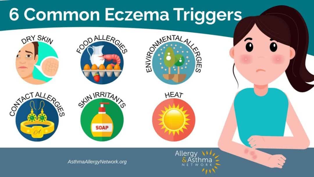 Illustration of a woman with eczema on her arm and six common eczema triggers: dry skin, food allergies, environmental allergies, contact allergies, skin irritants, and heat. Logos of Allergy & Asthma Network and AsthmaAllergyNetwork.org are included.