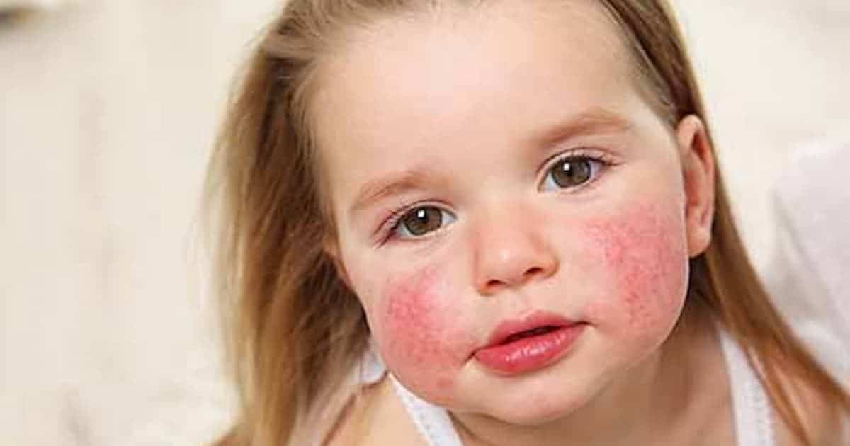 Photo of young girl with a rash on her face