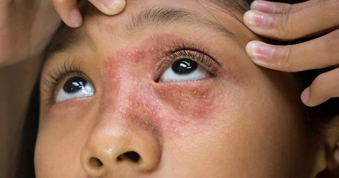 Close-up of a person's face with red, irritated skin around the eyes and forehead, likely due to contact dermatitis. The individual is holding their forehead, emphasizing the patchy rash and rough texture of the skin.