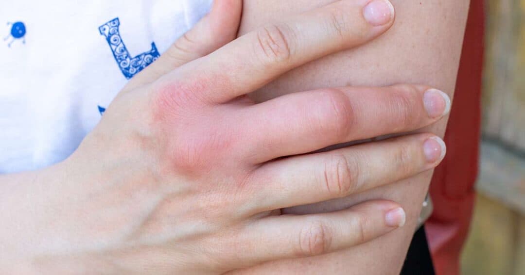 A close-up of a person's fingers wrapped around their arm, with the middle finger swollen and red, possibly indicating an allergic reaction or injury. The person is wearing a white shirt with blue designs.