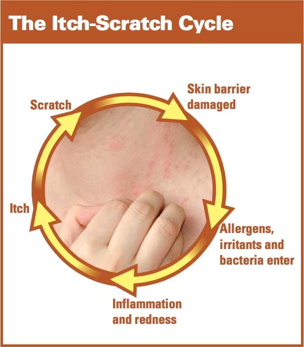 Diagram titled "The Itch-Scratch Cycle" showing a circular process: 1) Skin barrier damaged, 2) Allergens, irritants, and bacteria enter, 3) Inflammation and redness, 4) Itch, 5) Scratch. A hand scratches inflamed skin at the center.