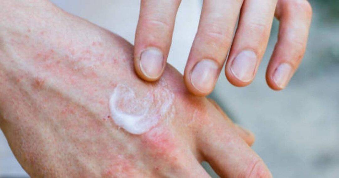 A person applies a small amount of cream to red, irritated skin on the back of their hand. The skin appears dry and inflamed, and the fingers are gently rubbing in the cream to help soothe the area.