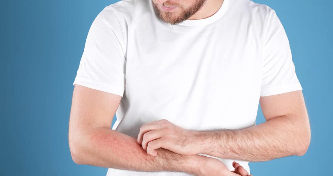A person in a white t-shirt is gently scratching their forearm, which shows signs of red and irritated eczema. The background is a solid blue color.