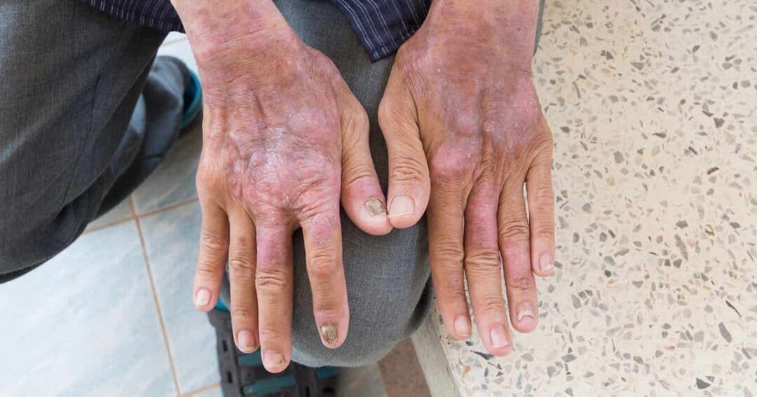 Man's hands on his knee showing the contact dermatitis rash on the back of his hands.