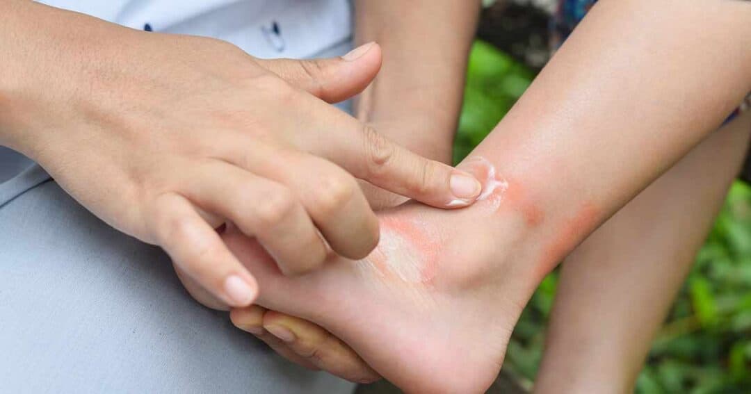 Close up of a parent's hands putting lotion on a young child's foot, that has a contact dermatitis rash.