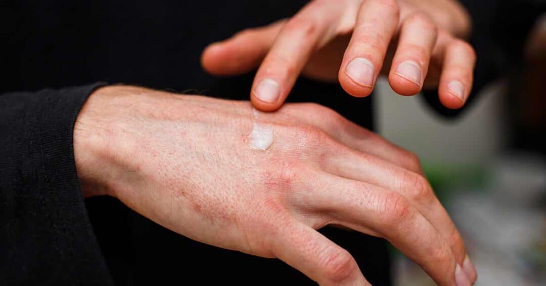 Image of hands rubbing contact dermatitis medication on the other hand.