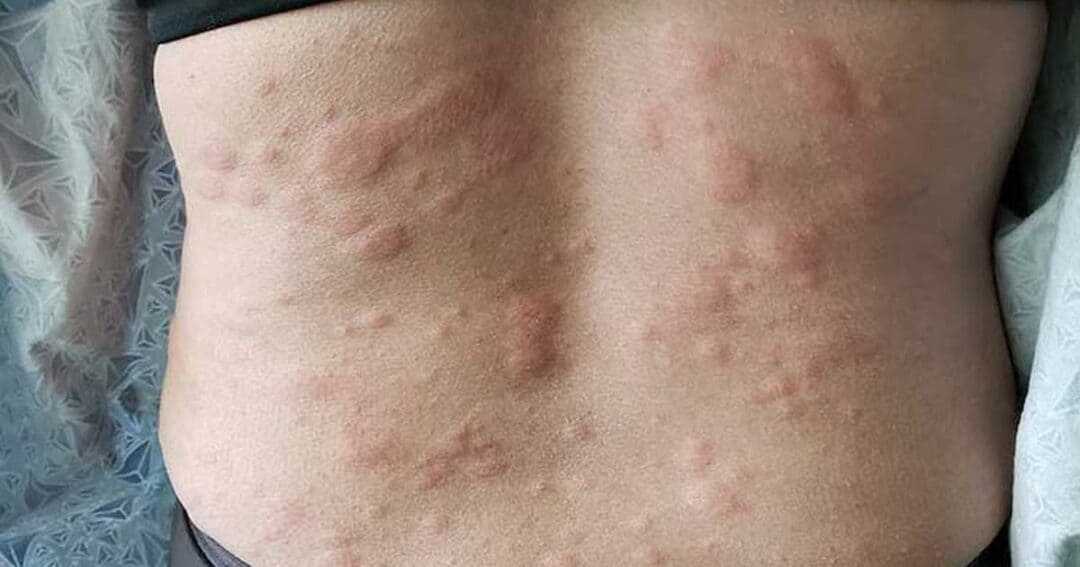 Close-up of a person's back showing a rash with numerous reddish bumps distributed across the skin. The person is wearing a black top, and the rest of the background is out of focus.