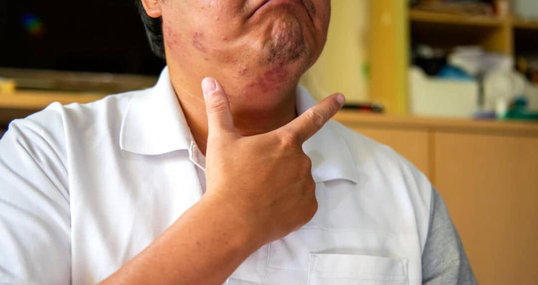What is Chronic Urticaria? 4 A person pointing to their chin, which shows visible hives. They are wearing a white shirt, and part of a room with shelves is visible in the background.
