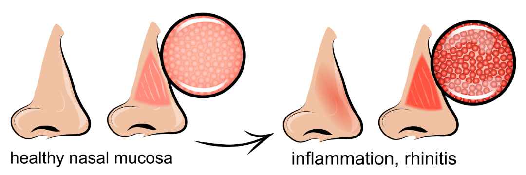 Illustration showing a comparison of healthy nasal mucosa and inflamed mucosa due to rhinitis. The healthy side shows normal texture, while the inflamed side is red and swollen, indicating irritation.