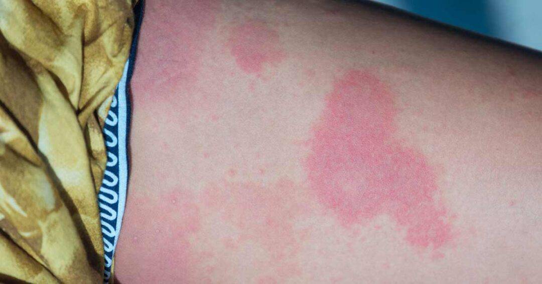 What is Chronic Urticaria? 3 red raised patches of Urticaria on womans leg