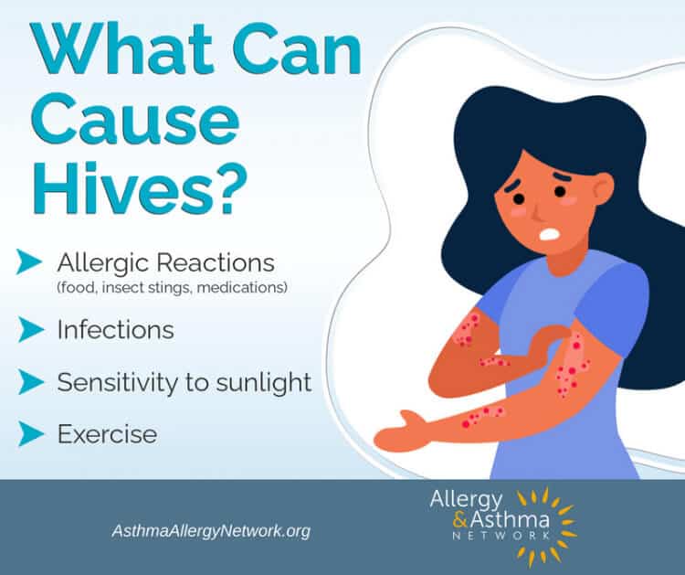 Illustration of a worried woman with red hives on her arms. Text reads "What Can Cause Hives?" with a list: allergic reactions, infections, sensitivity to sunlight, and exercise. Allergy & Asthma Network logo is at the bottom.