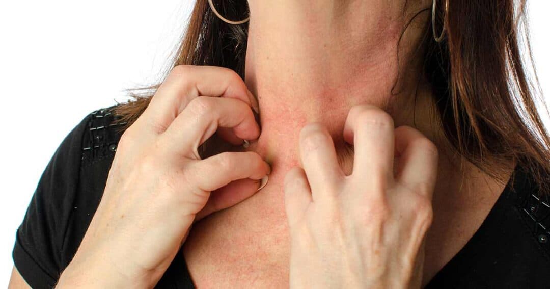 A person with eczema is scratching their itchy, red neck. They are wearing a black top, and only their neck, hands, and part of the hair are visible. The skin shows irritation with slight discoloration.
