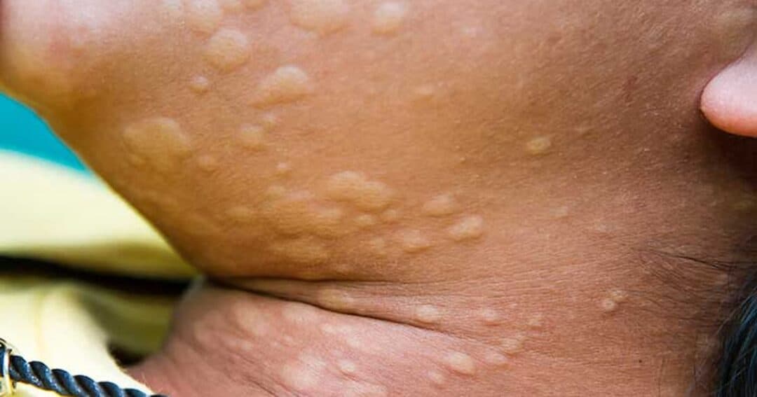 closeup of hives on the neck of a person