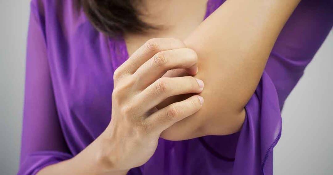 What is Chronic Urticaria? 5 A person wearing a purple shirt scratches their elbow with their right hand. The focus is on the arm and hand, suggesting discomfort or itchiness.